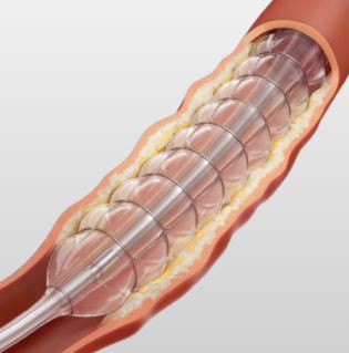 Nitinol Braided PTA Balloon
